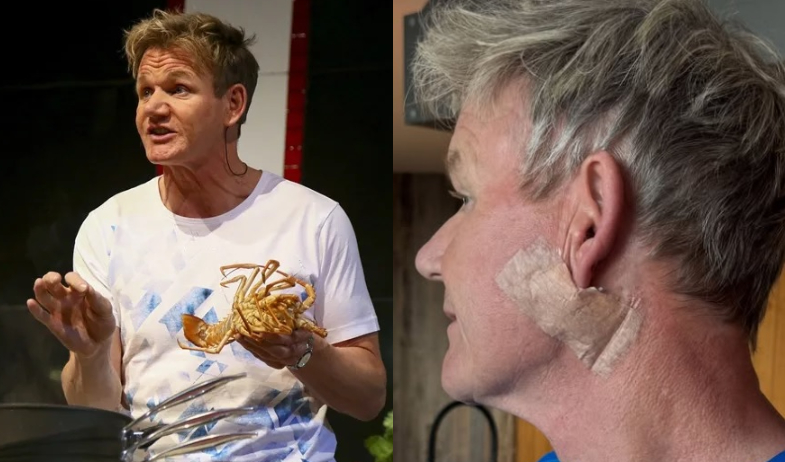 El chef televisivo Gordon Ramsay se somete a una cirugía para eliminar un cáncer de piel 