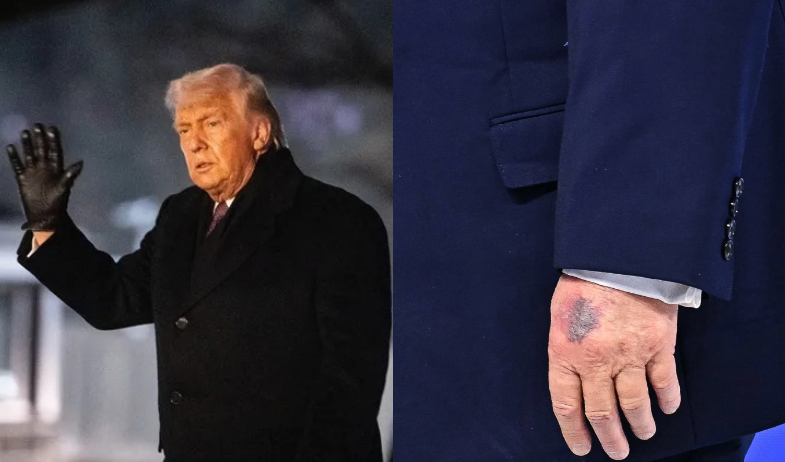 ¡Un moratón y muchas preguntas! Trump responde sobre su estado de salud 