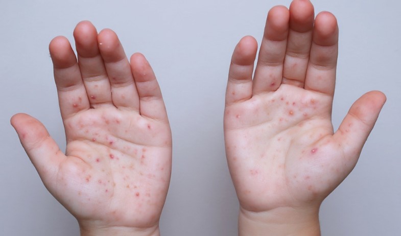 Minsa intensifica medidas de prevención frente al repunte regional de sarampión 