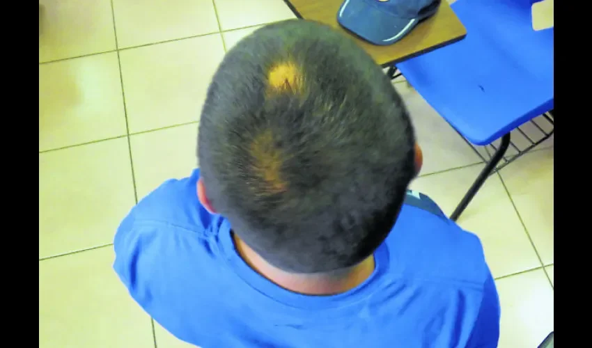 Existen diferentes tipos de alopecia, en ocasiones es provocada por el uso excesivo de gel.