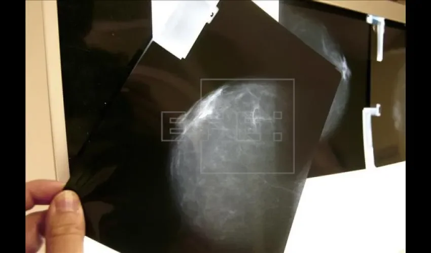 Radiografía cáncer