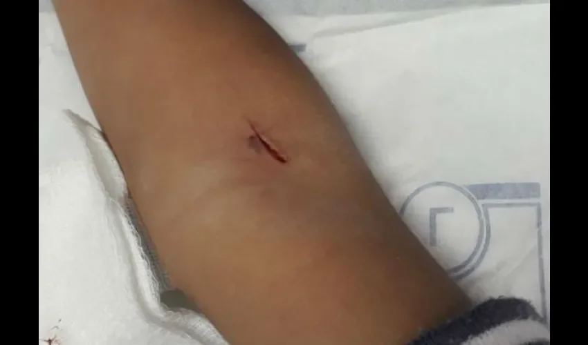 Debido a la profundidad de la herida se requirieron dos puntos de sutura. 