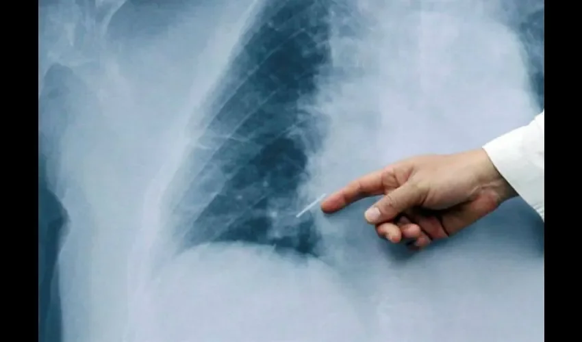 Radiografía de cáncer de pulmón.  