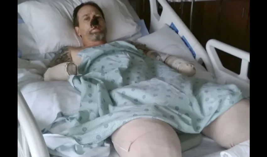 Ha sido amputado de brazos y pierna por extraña enfermedad. 