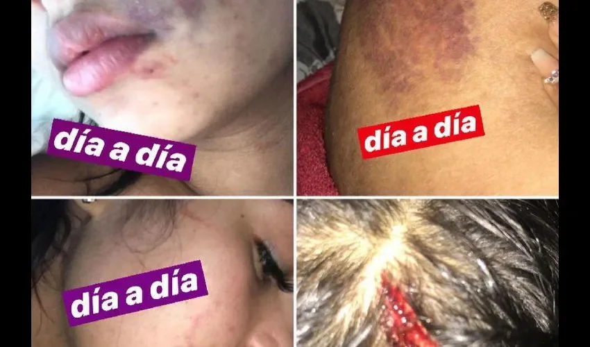 Supuestos golpes de tatiana Vélez. Foto: Instagram